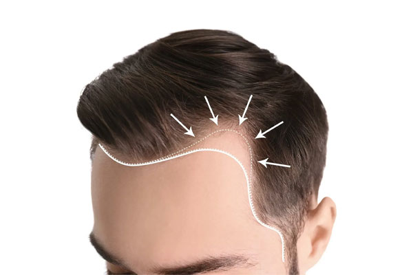 ریزش مو بصورت خطی