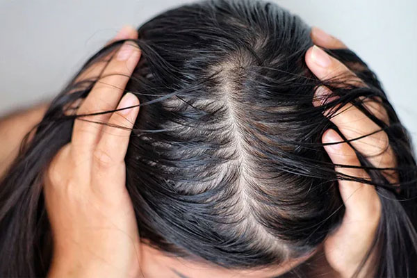 علل افزایش چربی سر