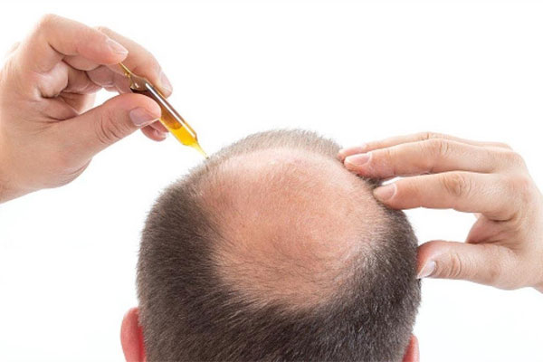 روشهای درمانی و پیشگیرانه ریزش مو