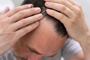تفاوت ریزش مو ارثی و هورمونی چیست ؟