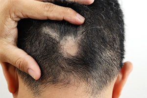ریزش مو قارچی